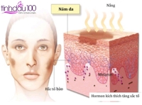 Trị nám với tinh dầu nguyên chất từ thảo mộc