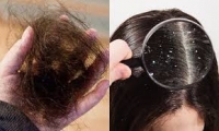 Giải pháp cho tóc gàu, gãy rụng, tóc xơ rối