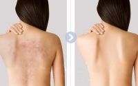 Bạn đã có phương pháp trị mụn cơ thể chưa??