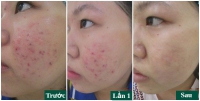 Mụn mủ, mụn bọc, mụn đầu đen biến mất hoàn toàn bằng dầu massage mặt trị mụn Cúc La Mã. Bạn đã thử chưa??