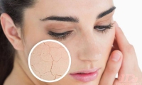 Chữa da khô, nứt nẻ với mỡ trăn U Minh Hạ
