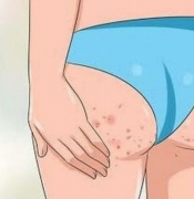 6 Cách chữa mụn, thâm ở mông tại nhà cực hiệu quả