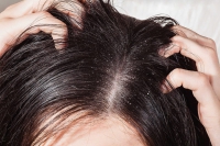 Để gàu, rụng tóc không còn là nỗi ám ảnh