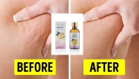 Khắc phục tình trạng da sần vỏ cam với tinh dầu gừng