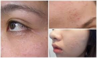Dầu massage mặt cúc la mã - sự lựa chọn cho làn da mệt mỏi vì mụn