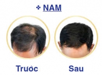 Giải pháp cải thiện rụng tóc, hói đầu,hiệu quả.
