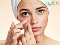 Một số lưu ý khi chăm sóc cho da bị mụn.