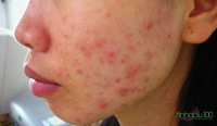 Những dấu hiệu nhận biết 1 làn da nhiễm corticoid