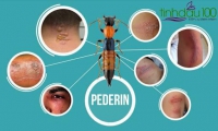 Cách giảm sưng, ngứa khi bị kiến/bọ đốt