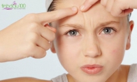 Trẻ em dậy thì bị mụn thì nên dùng gì ?
