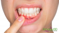 Nước Xịt thơm miệng Cool Breath có ngăn ngừa được nhiệt miệng, sâu răng, chảy máu chân răng, viêm nướu?