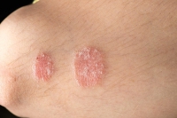 Xua tan nỗi lo về vảy nến, chỉ cần sử dụng muối tắm himalayan bạn đã thử chưa.
